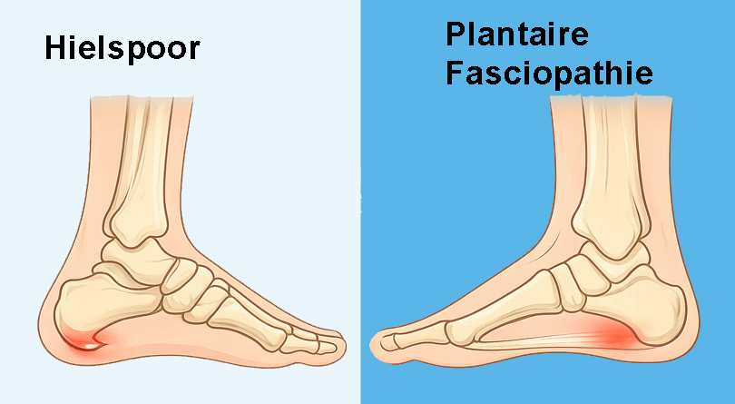 hielspoor en plantaire fasciopathie
